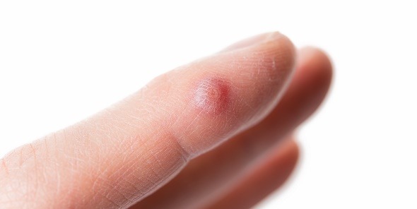 Cryotherapy For Wart Removal – Quick And Effective Treatment